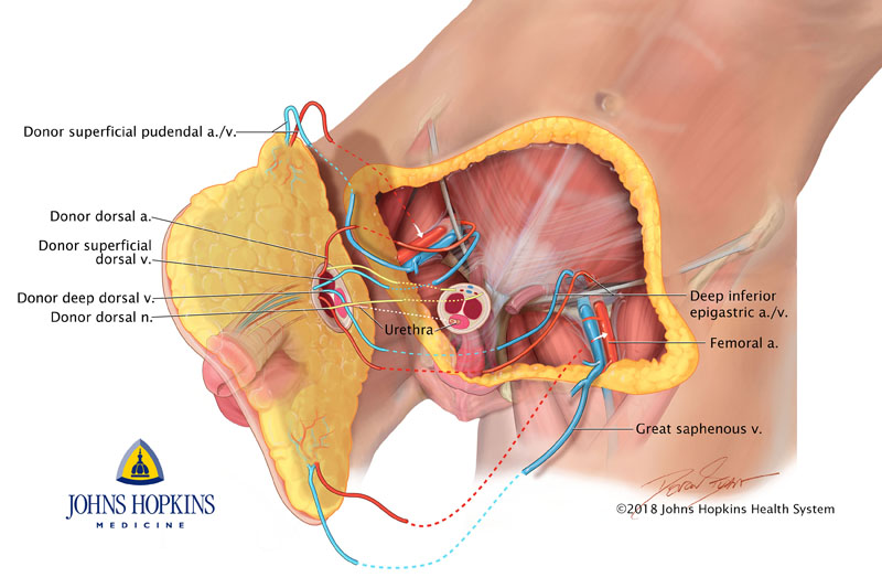 How surgeons at Johns Hopkins Hospital performed penis and scrotum transplant